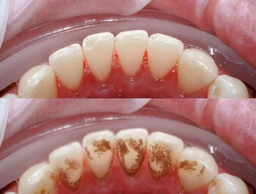 Eucryl Toothpaste nhanh chóng len lỏi vào sâu kẽ răng giúp loại bỏ mảng bám, vết ố vàng dễ dàng